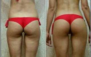 Сжигаем жир на ягодицах: как убрать складку под попой — инструкция по преображению Вашей мадам Сижу!