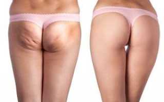 Борьба с целлюлитом в домашних условиях – секреты победы
